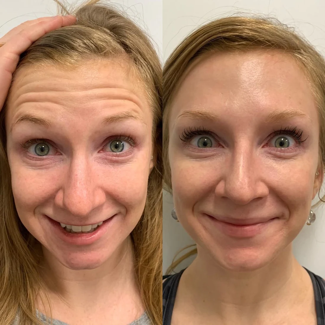Wrinkle relaxers before and after: Forehead lines
