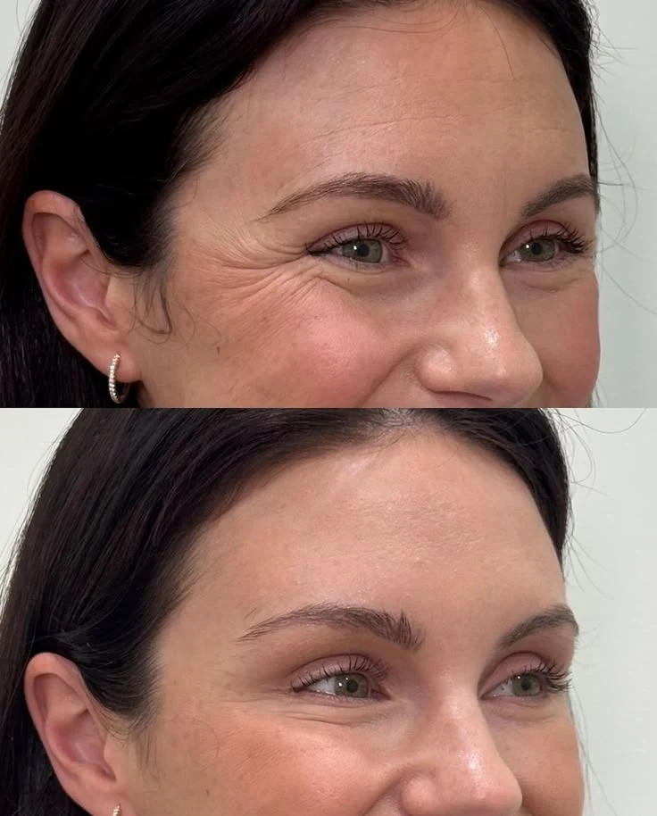 Wrinkle relaxers before and after: Crow's feet