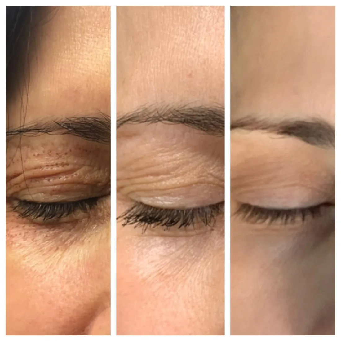 Upper eyelid: treatment day, healing, and result