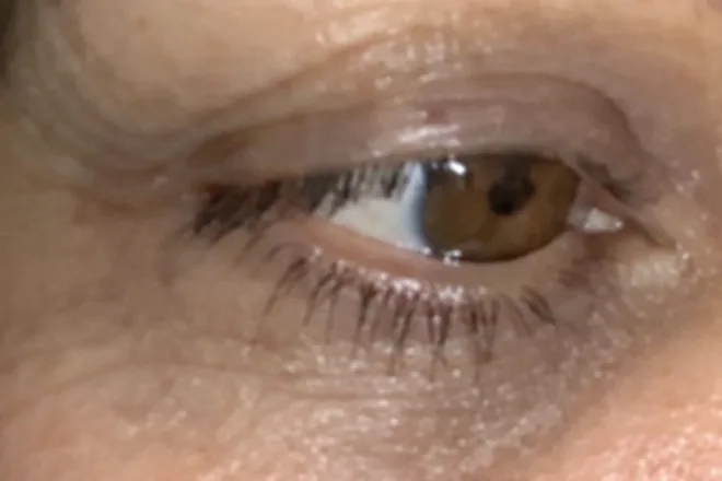 After: eye area
