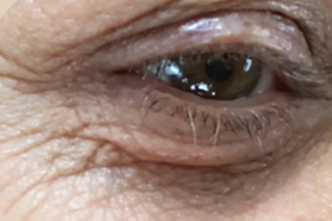 Before: eye area