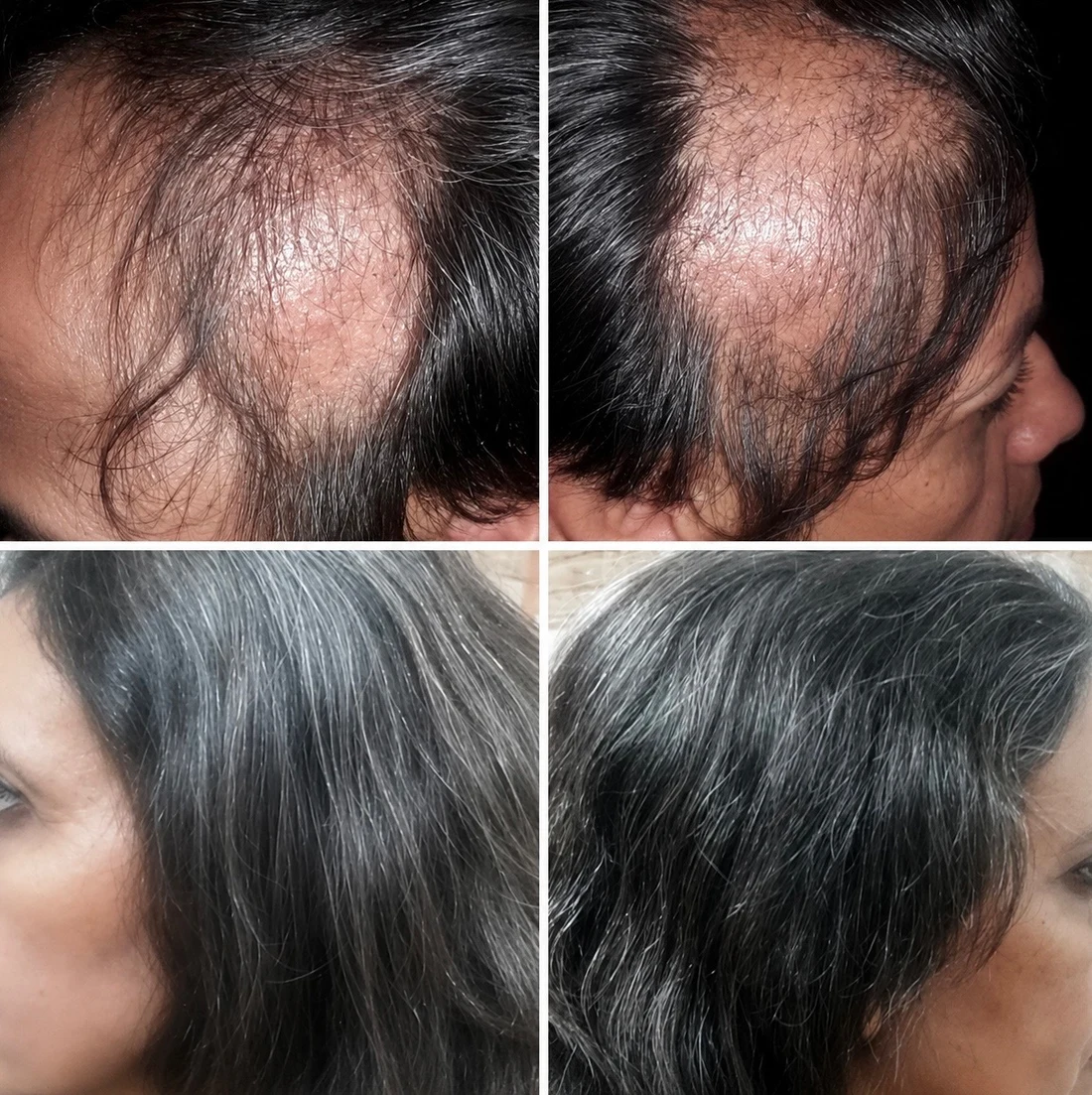 Temple and side thinning: before and after