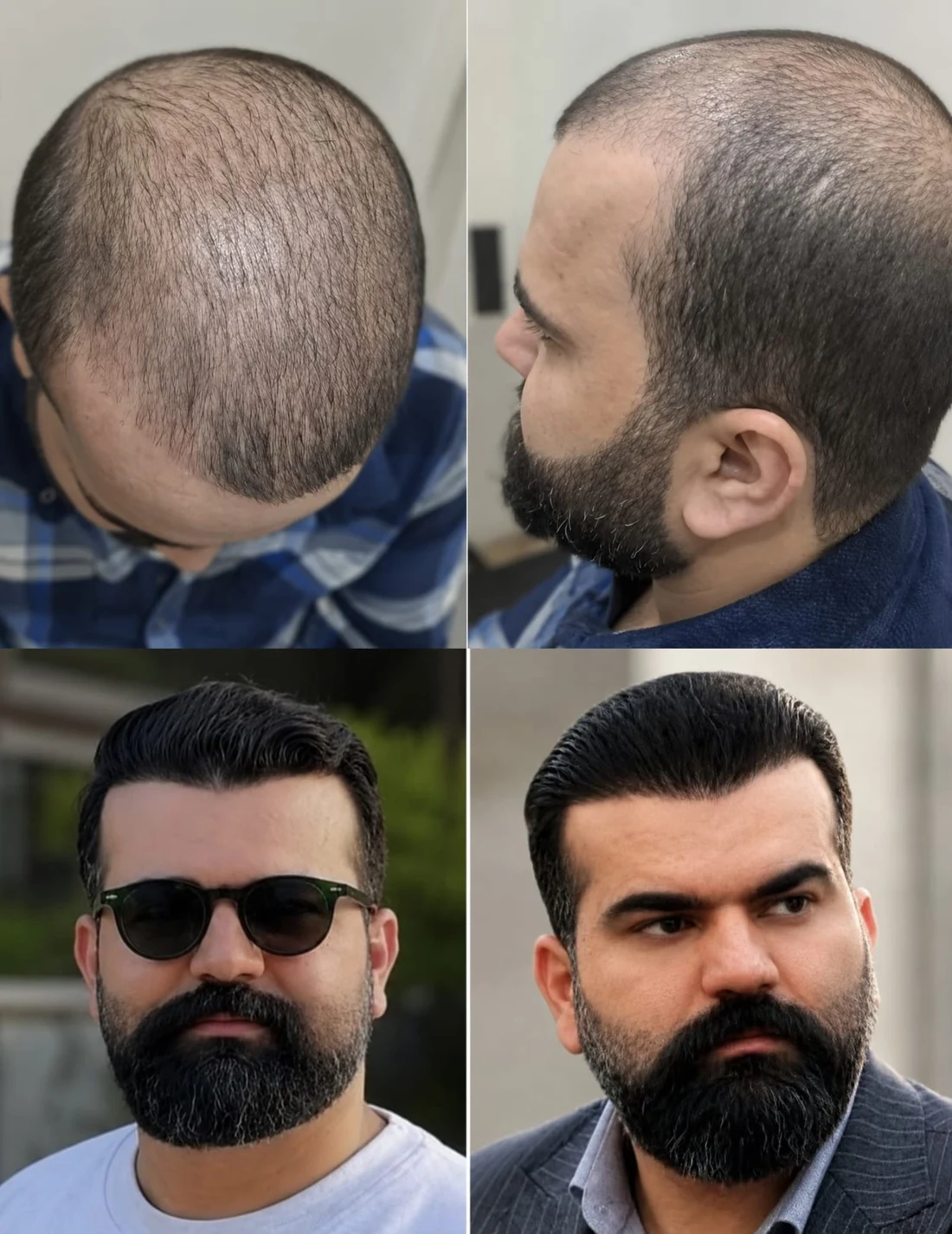 Crown and temples: before and after