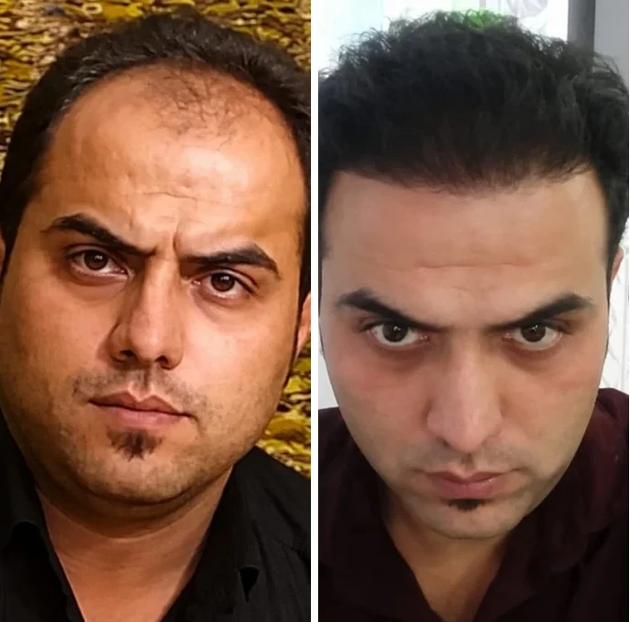 Hair transplant before and after: Receding hairline