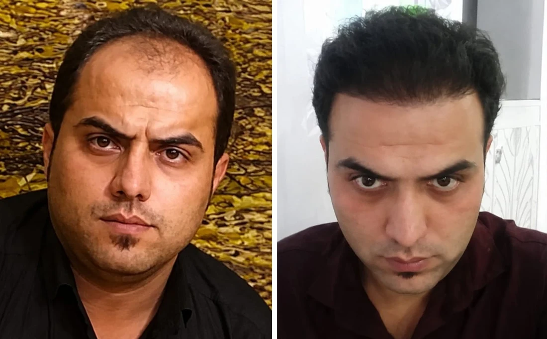Receding hairline: before and after