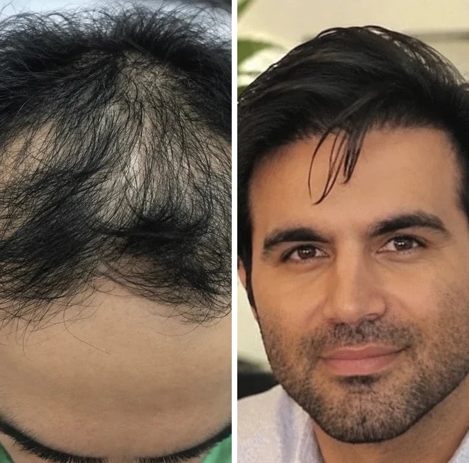 Hair transplant before and after: Crown and front