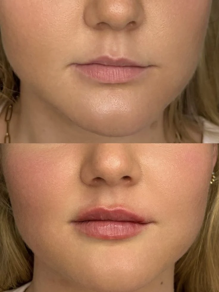 Lip filler before and after: Fuller, defined lips