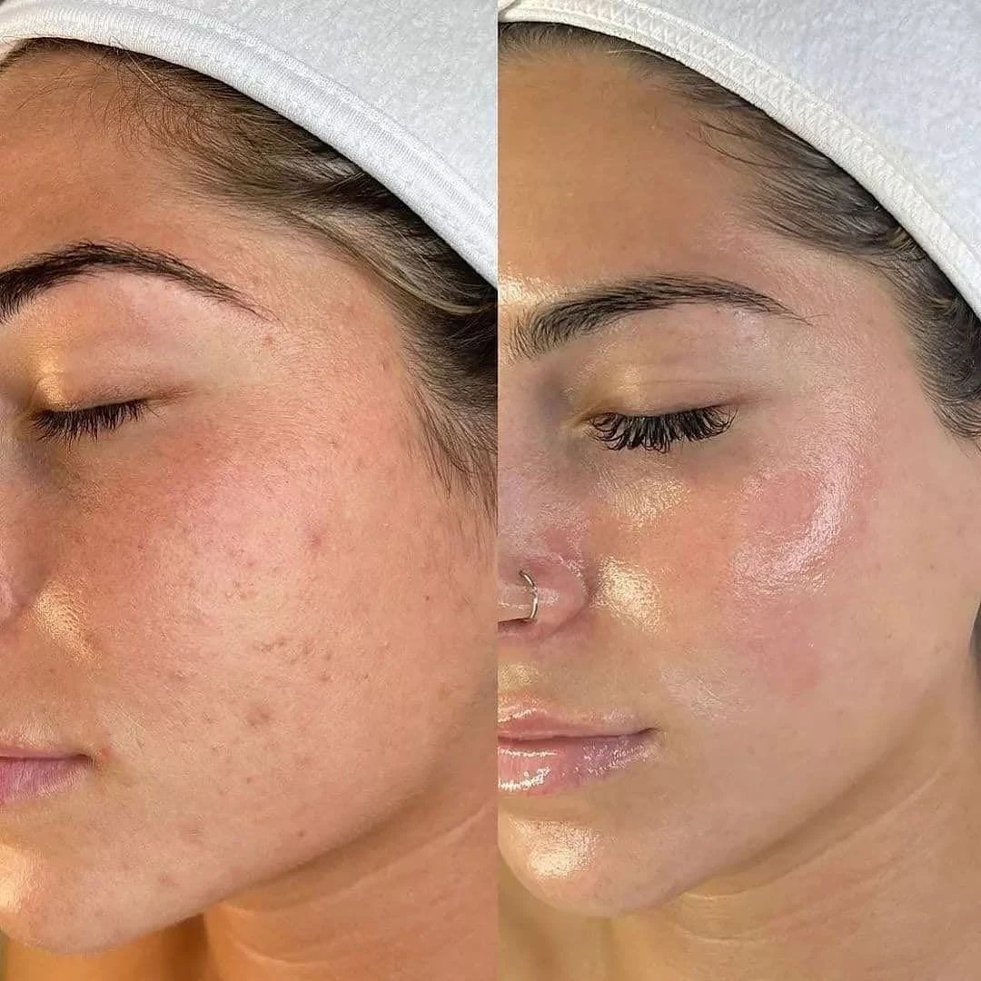 Microneedling before and after: Acne marks and texture