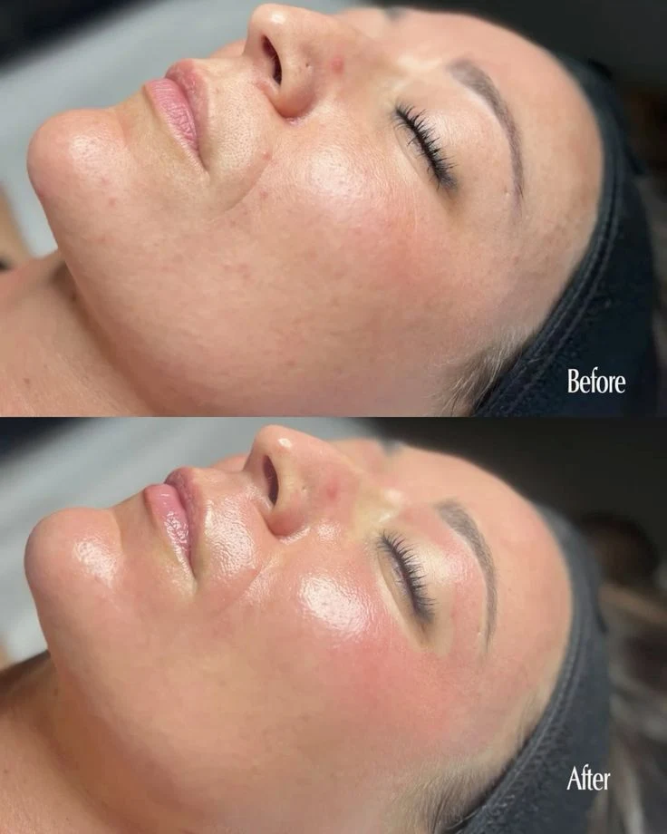 Overall glow: before and after