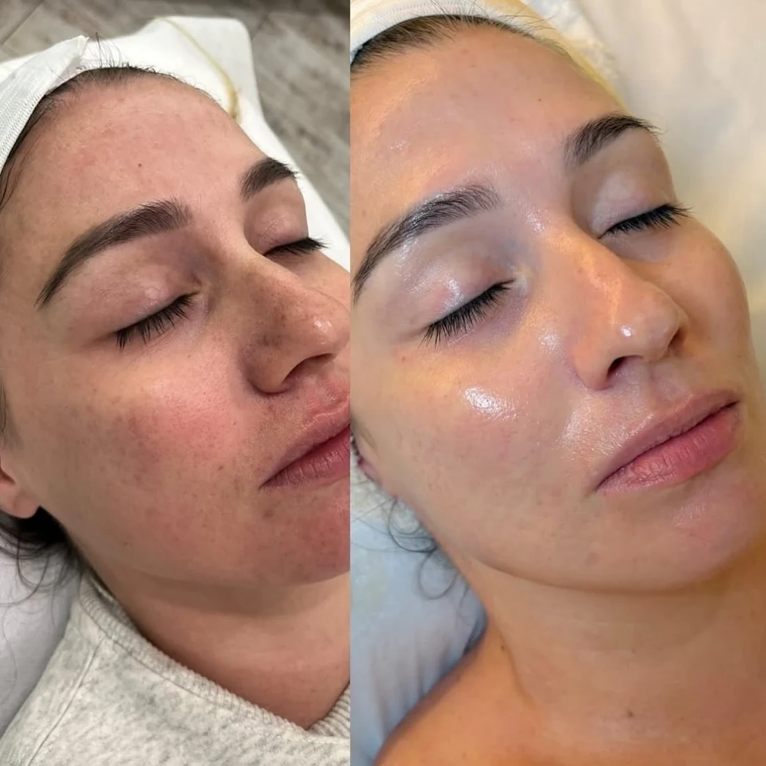 Microneedling before and after: Tone and pores