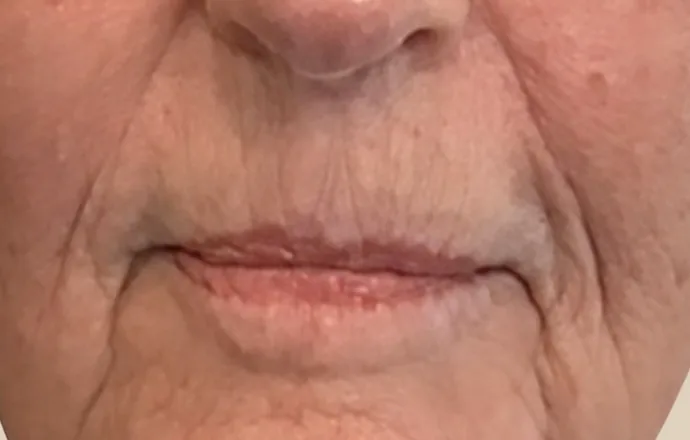 After: around the mouth