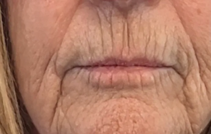 Before: around the mouth