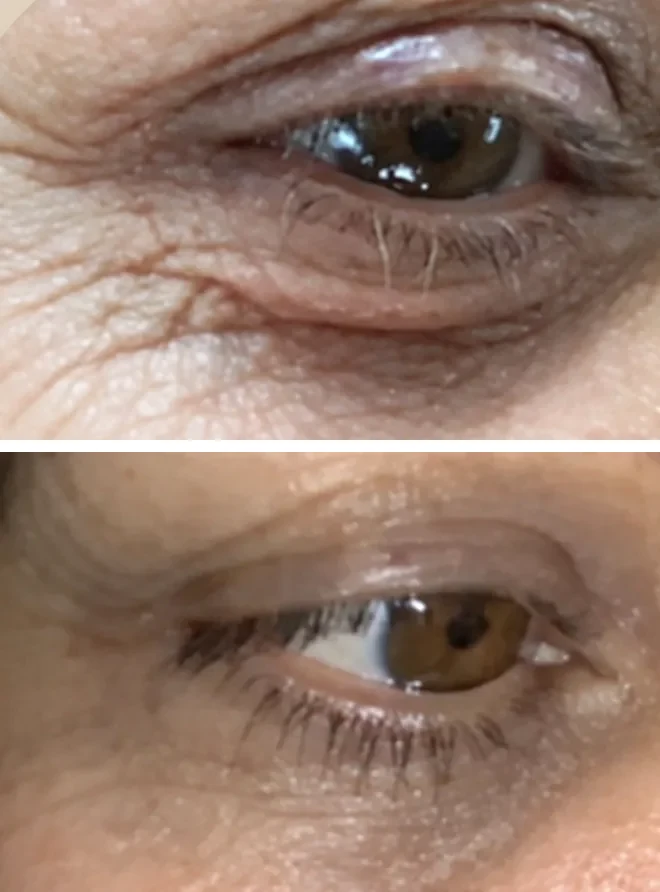 Plexr Plus before and after: Eye area