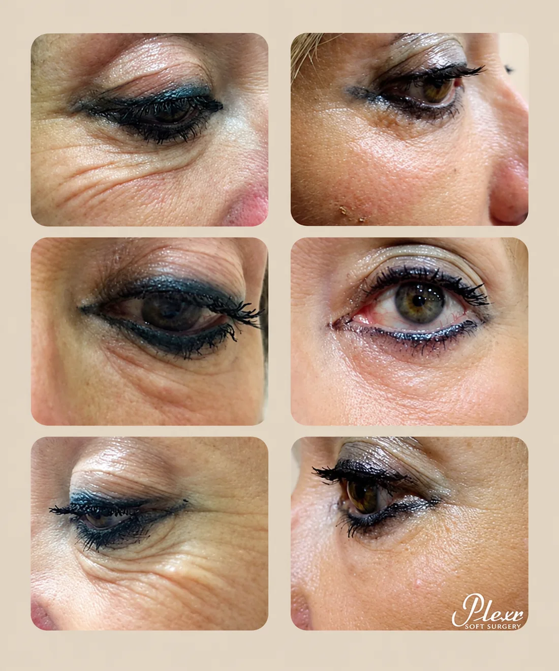 Plexr eyelid results, before (left) and after (right)