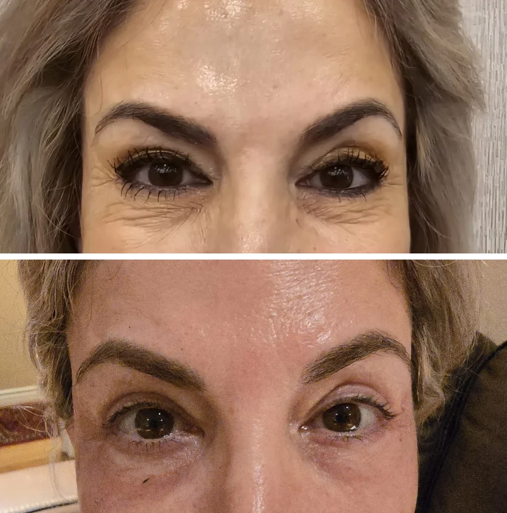 Plexr Plus before and after: Under-eye crepey skin