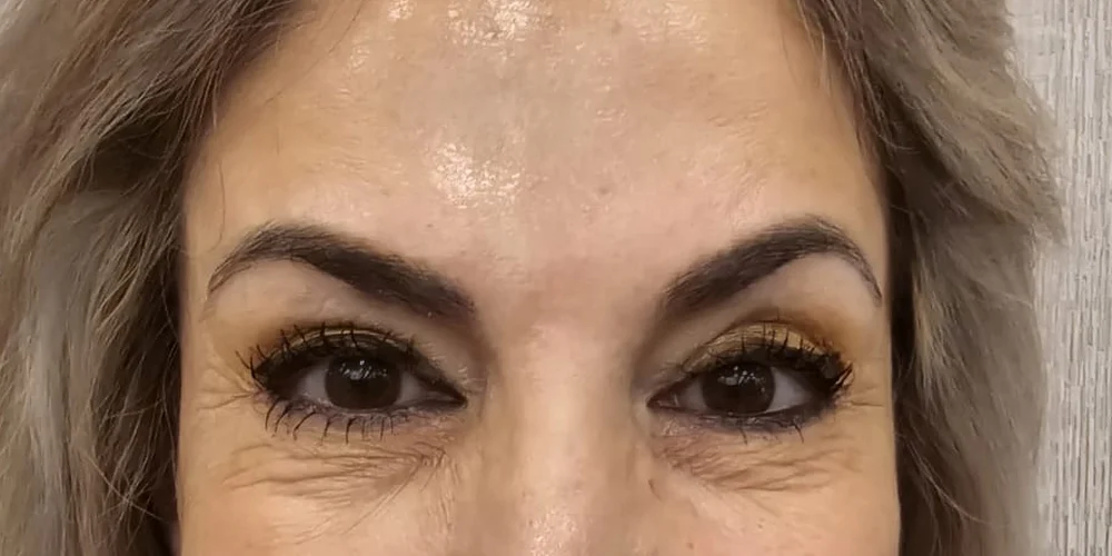 Before: crepey under-eye skin