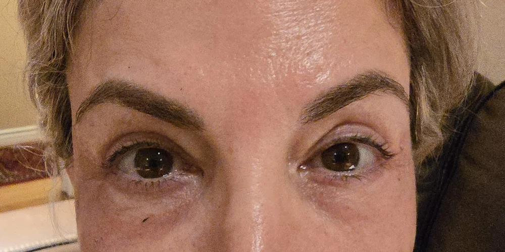 After: healed, smoother under-eye skin